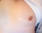 A solitary, hypopigmented patch on the chest of an adult