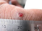 A solitary papule of inflamed vascular granulation tissue on the index finger of an adult