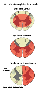 uncomplete cord syndromes