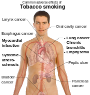 head and torso of a male with internal organs shown and labels referring to the effects of tobacco smoking