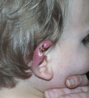 Ulceration and crusting on the upper portion of an ear