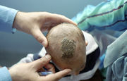 A large brown colored plaque on the top of a child's head