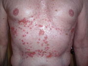 Adult chest and abdomen with many red skin lesions