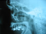 Grayscale x-ray image of a human skull. This left lateral cephalametric radiograph shows a profile of the human skull. The maxilla and some crowned teeth make up most of the image. Above that four faint nail like structures are visible.