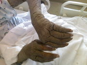 Diffuse thickening of the skin over an adult's bilateral arms and fingers