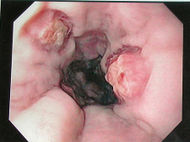 Esophageal varices - post banding.jpg