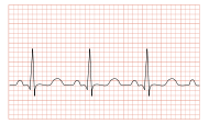 Tachycardia ECG paper.svg