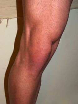 Male Knee by David Shankbone.jpg