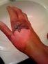 Second-degree burn caused by contact with boiling water