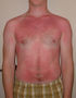 A sunburn is a typical first degree burn.