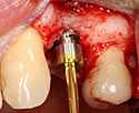 Healing abutment