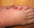 Cutaneous-larva-migrans-foot.jpg