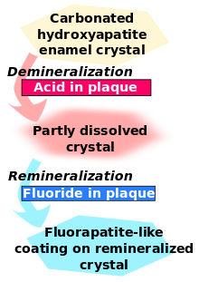 Carbonated hydroxyapatite enamel crystal is demineralised by acid in plaque and becomes partly dissolved crystal. This in turn is remineralised by fluoride in plaque to become fluorapatite-like coating on remineralised crystal.