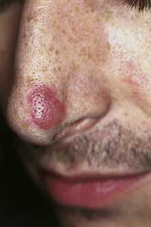 Facial eosinophilic granuloma.jpg