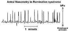 A line graph. The line has pronounced upwards spikes followed by less pronounced downward spikes. These spikes are separated by longer intermittent periods where the line is jagged, but roughly and statistically straight.