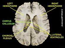  Corpus callosum