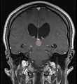 Tumor Pineocytoma2.JPG