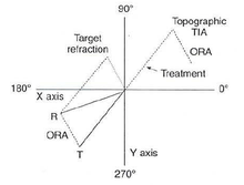 Double-angle vector diagram (DAVD) shows a patient having a discrepancy between refractive astigmatism (R) and corneal topographic astigmatism (T).