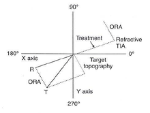 Double-angle vector diagram (DAVD) shows a patient having a discrepancy between refractive astigmatism (R) and corneal topographic astigmatism (T).