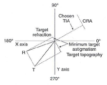 Double-angle vector diagram (DAVD) shows a patient having a discrepancy between refractive astigmatism (R) and corneal topographic astigmatism (T).