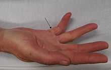 A human hand, suffering from Dupuytren's contracture, causing it to contract into a claw-like position