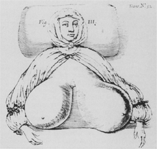 In 1670, the physician Durston drew this illustration of first recorded case of non-gravid gigantomastia; the woman died of the condition.
