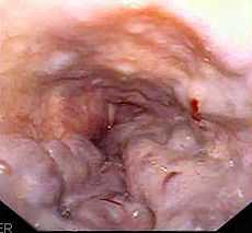 Purple longitudinal tubular structures with red spots in the esophagus at the time of endoscopy