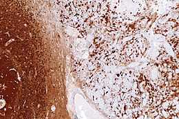 Image of gliosis in tissue