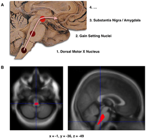 Composite of three images, one in top row (referred to in caption as A), two in second row (referred to as B). Top shows a mid-line sagittal plane of the brainstem and cerebellum. There are three circles superimposed along the brainstem and an arrow linking them from bottom to top and continuing upward and forward towards the frontal lobes of the brain. A line of text accompanies each circle: lower is "1. Dorsal Motor X Nucleus", middle is "2. Gain Setting Nuclei" and upper is "3. Substantia Nigra/Amygdala". A fourth line of text above the others says "4. ...". The two images at the bottom of the composite are magnetic resonance imaging (MRI) scans, one saggital and the other transverse, centred at the same brain coordinates (x=-1, y=-36, z=-49). A colored blob marking volume reduction covers most of the brainstem.