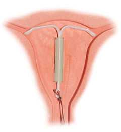 a hormonal intrauterine device