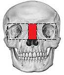 Box osteotomy