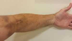 A hematoma caused by a patient moving their arm during a plateletpheresis donation.