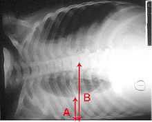 An X-ray showing a chest lying horizontal. The lower black area, which is the right lung, is smaller with a whiter area below it of a pulmonary effusion. There are red arrows marking the size of these.
