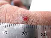 Pyogenic granuloma on a finger-1.jpg