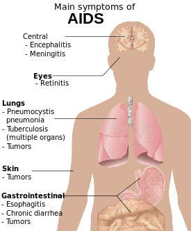 A diagram of a human torso labelled with the most common symptoms of AIDS