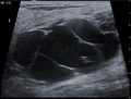 Ultrasound image Cystic Hygroma 20170535218 17F.jpg