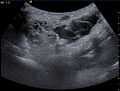 Ultrasound image Cystic Hygroma 20172337984 17F.jpg