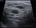 Ultrasound image Cystic Hygroma 20172558781 17F.jpg