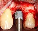 The implant fixture is turned into the osteotomy.  Ideally, it is completely covered by bone and has no movement within the bone.