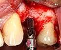 A series of slow-speed drills create and gradually enlarge a site in the jaw for the implant to be placed.  The hole is called an osteotomy.