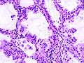 Brochiolo-alveolar carcinoma with mucin production (1).jpg