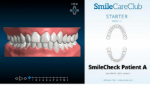 This is an example of a SmileCareClub treatment plan for crowding