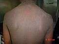 Familial acanthosis nigricans2.jpg