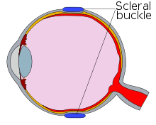 Diagram of an eye with a scleral buckle, in cross-section.