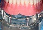 Implant retained overdenture