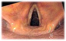 View of the glottis as seen during laryngoscopy