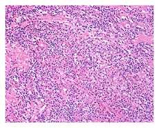 Low power view of IgG4-related prostatitis