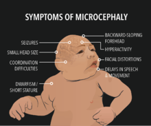 symptoms of microcephaly