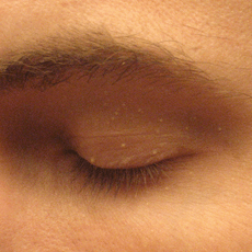 Close-up view of an adult eyelid on which there are numerous small, elevated skin lesions filled with white material