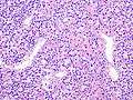 Parathyroid adenoma histopathology (1).jpg